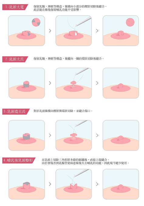 女人的奶頭|乳頭內凹、長毛正常嗎？ 8類「乳頭形狀」你的是哪種